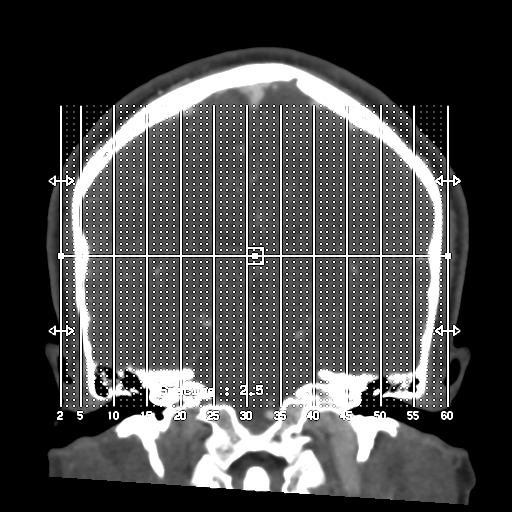 Cerebral arteriovenous malformation (Radiopaedia 39259-41505 Sagittal 1).png