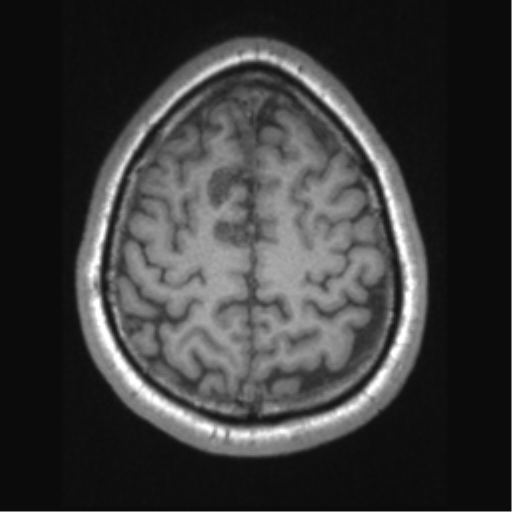 Cerebral arteriovenous malformation (Radiopaedia 39259-41506 Axial T1 62).png