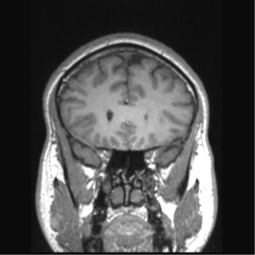 Cerebral arteriovenous malformation (Radiopaedia 39259-41506 Coronal T1 67).png