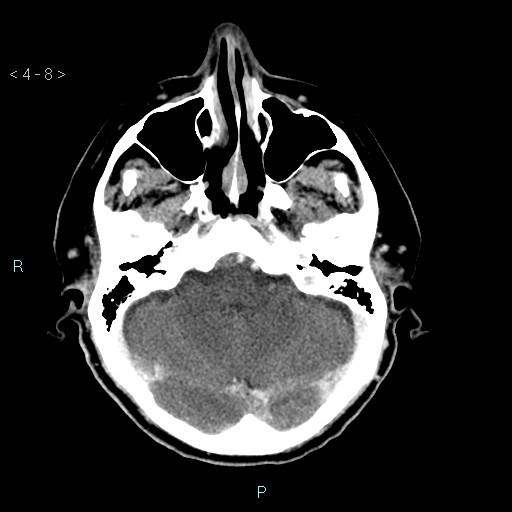 File:Cerebral arteriovenous malformation (Radiopaedia 40528-43125 Axial C+ delayed 8).jpg