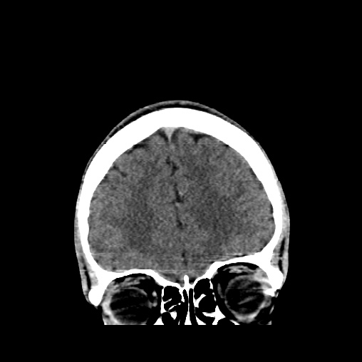 File:Cerebral arteriovenous malformation (Radiopaedia 61964-70028 Coronal non-contrast 13).jpg