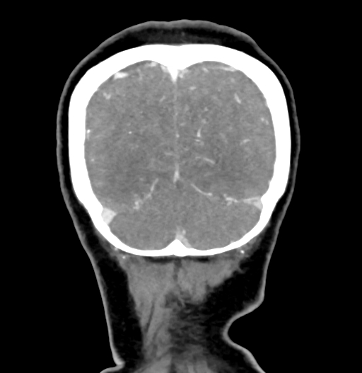 Cerebral arteriovenous malformation (Radiopaedia 73830-84645 C 84).jpg
