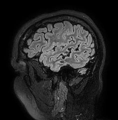 Cerebral arteriovenous malformation (Radiopaedia 74411-85654 Sagittal FLAIR 18).jpg