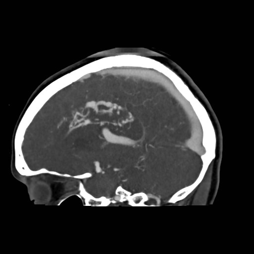 File:Cerebral arteriovenous malformation (Radiopaedia 79677-92888 C 28).jpg