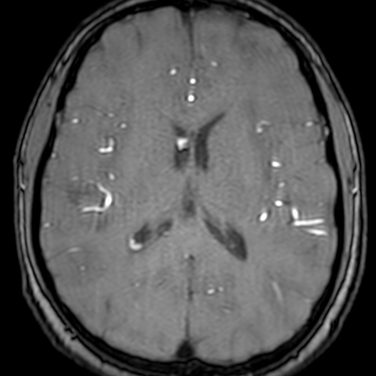 Cerebral arteriovenous malformation at posterior body of corpus callosum (Radiopaedia 74111-84925 Axial MRA 127).jpg