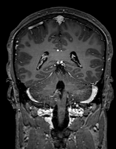 Cerebral arteriovenous malformation at posterior body of corpus callosum (Radiopaedia 74111-84925 K 246).jpg