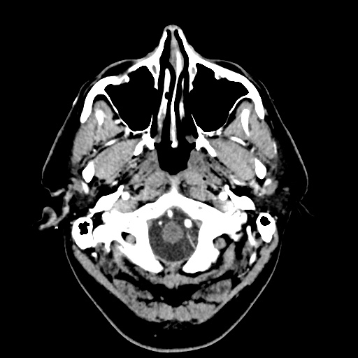 Cerebral arteriovenous malformation with lobar hemorrhage (Radiopaedia 35598-57216 A 5).jpg