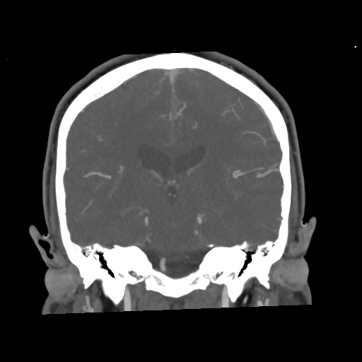 Cerebral arteriovenous malformation with lobar hemorrhage (Radiopaedia 35598-57216 C 53).jpg
