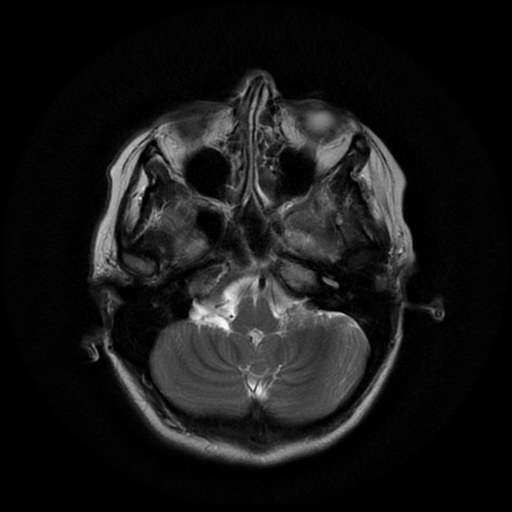 File:Cerebral autosomal dominant arteriopathy with subcortical infarcts and leukoencephalopathy (CADASIL) (Radiopaedia 41018-43768 Ax T2 PROP 4).png