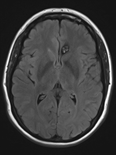 File:Cerebral cavernoma and development venous anomaly (Radiopaedia 37603-39482 Axial FLAIR 12).png