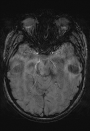 File:Cerebral cavernoma and development venous anomaly (Radiopaedia 37603-39482 Axial SWI 15).png