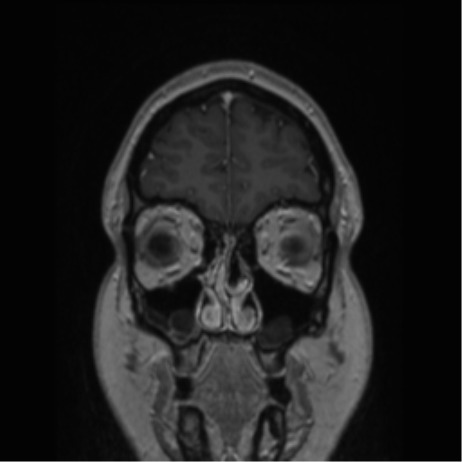 Cerebral cavernoma and development venous anomaly (Radiopaedia 37603-39482 Coronal T1 C+ 80).png