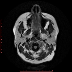 File:Cerebral cavernous malformation (Radiopaedia 26177-26306 FLAIR 2).jpg