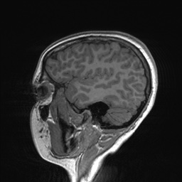 File:Cerebral cavernous venous malformation (Radiopaedia 70008-80021 Sagittal T1 59).jpg