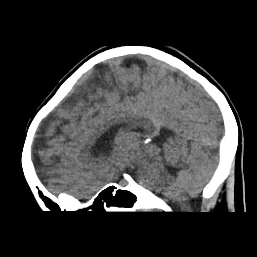 Cerebral cavernous venous malformation (Radiopaedia 70008-80022 C 28).jpg