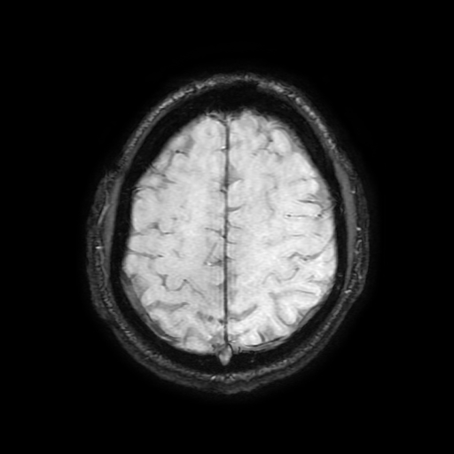 Cerebral cavernous venous malformation (Zabramski type II) (Radiopaedia 85511-101198 Axial SWI 94).jpg