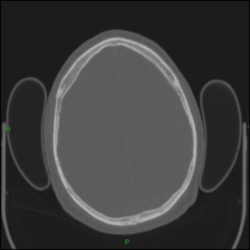 Cerebral contusions (Radiopaedia 33868-35039 Axial bone window 153).jpg
