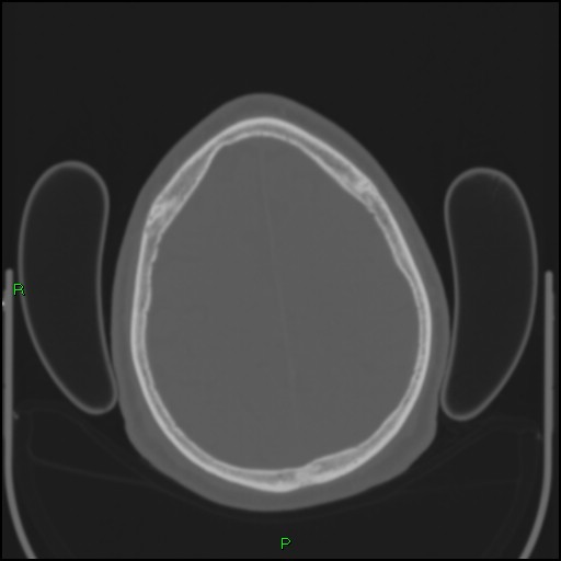 Cerebral contusions (Radiopaedia 33868-35039 Axial bone window 173).jpg