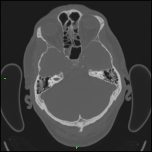 File:Cerebral contusions (Radiopaedia 33868-35039 Axial bone window 51).jpg