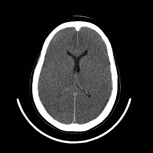 File:Cerebral edema (evolution in time) (Radiopaedia 19418-19439 non-contrast 56).jpg