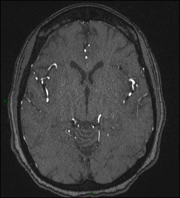 Cerebral fat embolism (Radiopaedia 35022-36525 Axial TOF 97).jpg