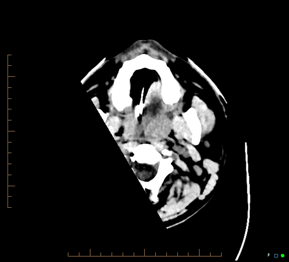 Cerebral fat embolism (Radiopaedia 85521-101220 Axial non-contrast 1).jpg