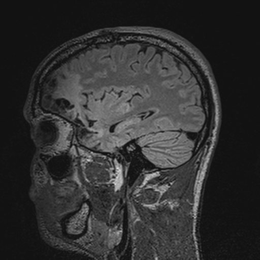 File:Cerebral hemorrhagic contusions- temporal evolution (Radiopaedia 40224-42757 Sagittal T1 58).png