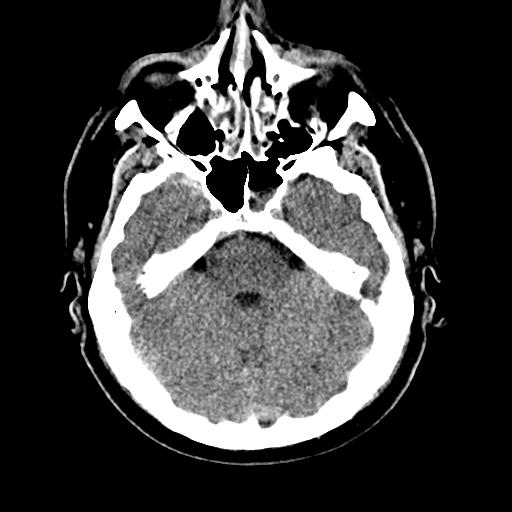 File:Cerebral hemorrhagic contusions and cervical spine fractures (Radiopaedia 32865-33841 Axial non-contrast 11).jpg