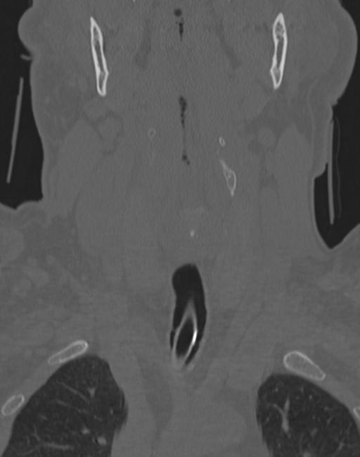 Cerebral hemorrhagic contusions and cervical spine fractures (Radiopaedia 32865-33841 Coronal bone window 13).jpg