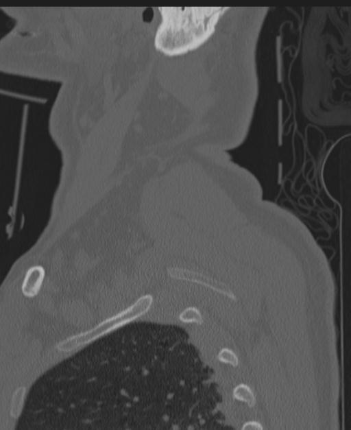 Cerebral hemorrhagic contusions and cervical spine fractures (Radiopaedia 32865-33841 Sagittal bone window 94).jpg