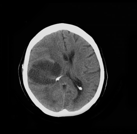 File:Cerebral infarction vs glioblastoma (Radiopaedia 10136-10676 Axial non-contrast 2).jpeg