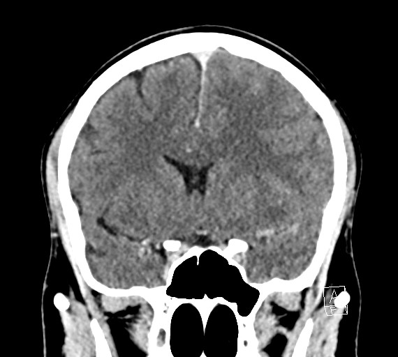 Cerebral metastases - testicular choriocarcinoma (Radiopaedia 84486-99855 D 25).jpg