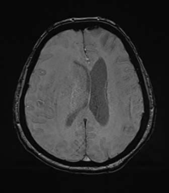Cerebral metastasis to basal ganglia (Radiopaedia 81568-95413 Axial SWI 55).png
