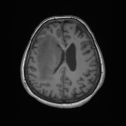 Cerebral metastasis to basal ganglia (Radiopaedia 81568-95413 Axial T1 50).png