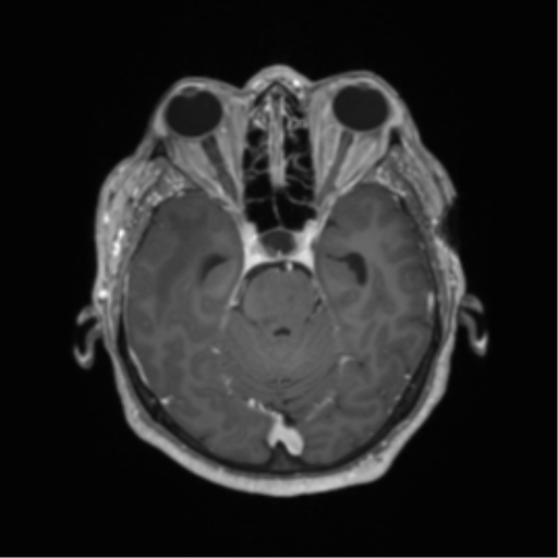 Cerebral metastasis to basal ganglia (Radiopaedia 81568-95413 Axial T1 C+ 23).png