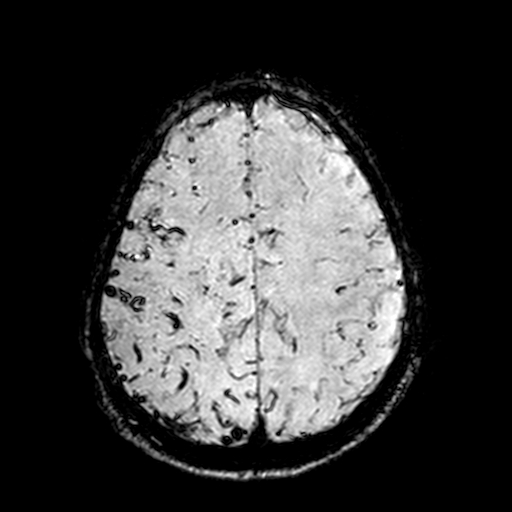 Cerebral parenchymal arteriovenous malformation (Radiopaedia 27280-27456 Axial SWI 92).jpg