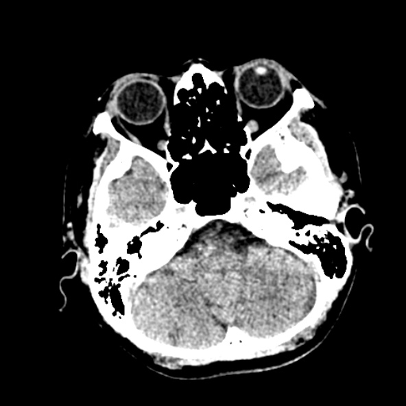 File:Cerebral ring enhancing lesions - cerebral metastases (Radiopaedia 44922-48818 Axial non-contrast 11).jpg