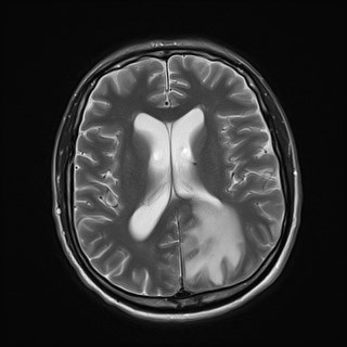 File:Cerebral toxoplasmosis (Radiopaedia 43956-47461 Axial T2 13).jpg