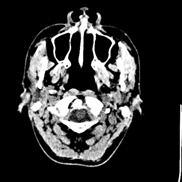 Cerebral toxoplasmosis (Radiopaedia 53993-60131 Axial non-contrast 5).jpg