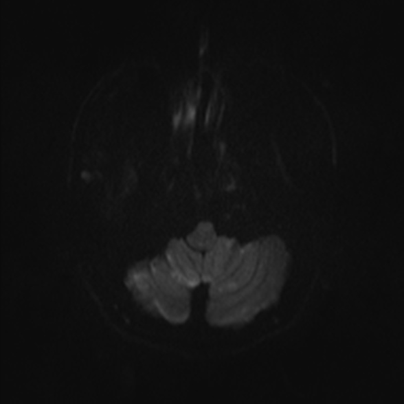 Cerebral toxoplasmosis (Radiopaedia 53993-60132 Axial DWI 30).jpg