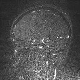 Cerebral tuberculosis with dural sinus invasion (Radiopaedia 60353-68090 Sagittal MRV 56).jpg