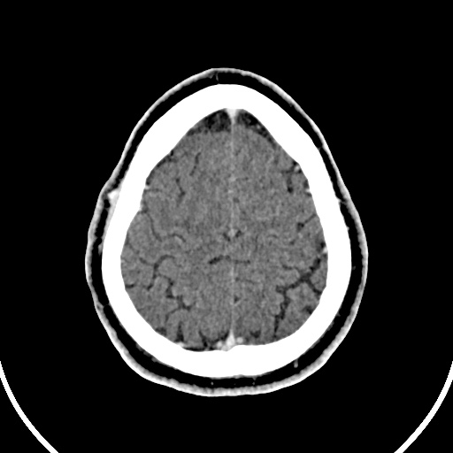 File:Cerebral venous angioma (Radiopaedia 69959-79977 B 89).jpg