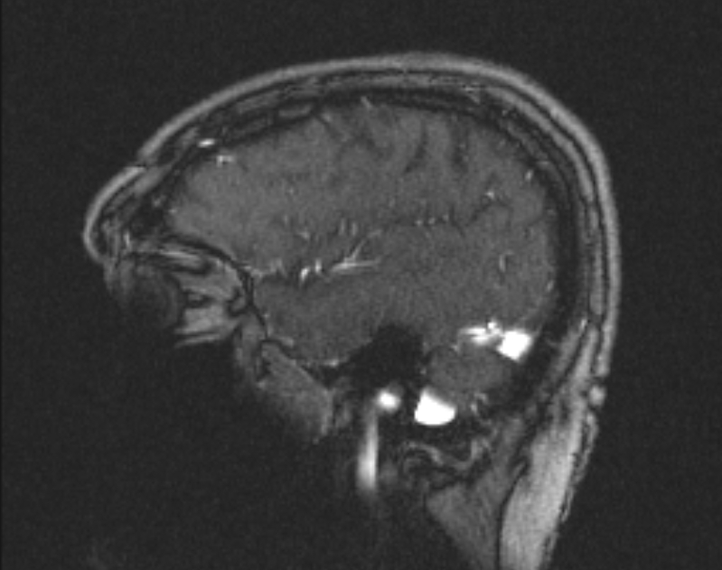 Cerebral venous infarction (Radiopaedia 65166-74176 Sagittal TOF 58).jpg