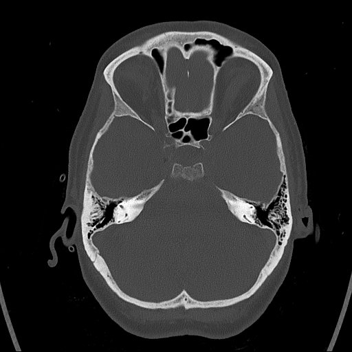 Cerebral venous infarction with hemorrhage (Radiopaedia 65343-74381 Axial bone window 34).jpg