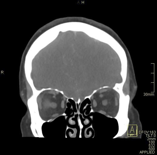 Cerebral venous sinus thrombosis (Radiopaedia 91329-108965 Coronal venogram 20).jpg