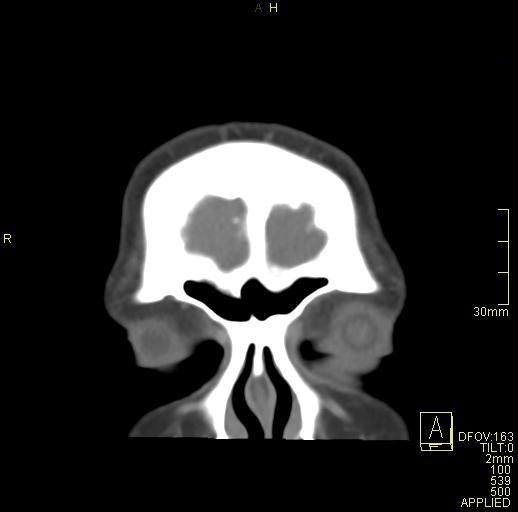 Cerebral venous sinus thrombosis (Radiopaedia 91329-108965 Coronal venogram 9).jpg