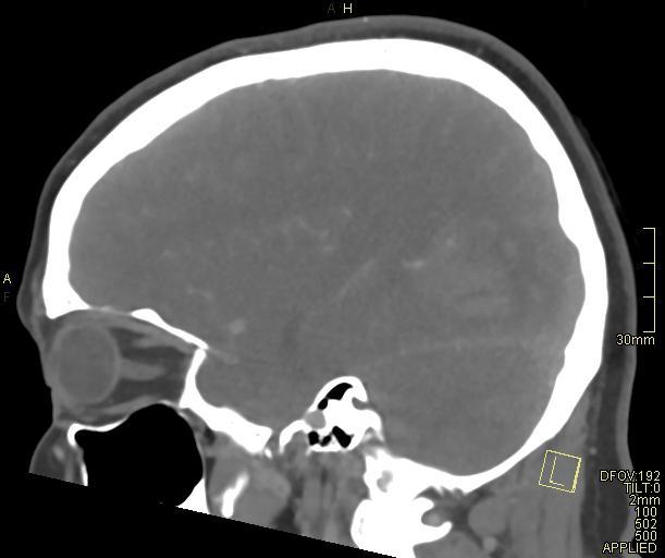 Cerebral venous sinus thrombosis (Radiopaedia 91329-108965 Sagittal venogram 52).jpg