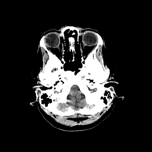 File:Cerebral venous throbmosis - hemorrhagic venous infarction (Radiopaedia 87318-103613 Axial non-contrast 25).jpg