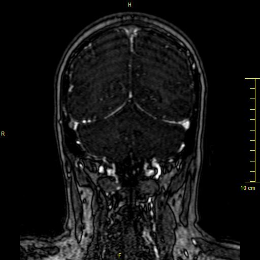 Cerebral venous thrombosis (Radiopaedia 23288-23351 MRV 124).JPG