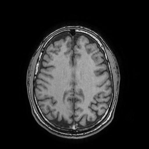 Cerebral venous thrombosis with secondary intracranial hypertension (Radiopaedia 89842-106957 Axial T1 118).jpg